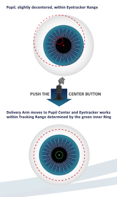 Lazer Göz uygulama tekniği, Eye tracker, göz takip sistemi, Excelsius Excimer Laser